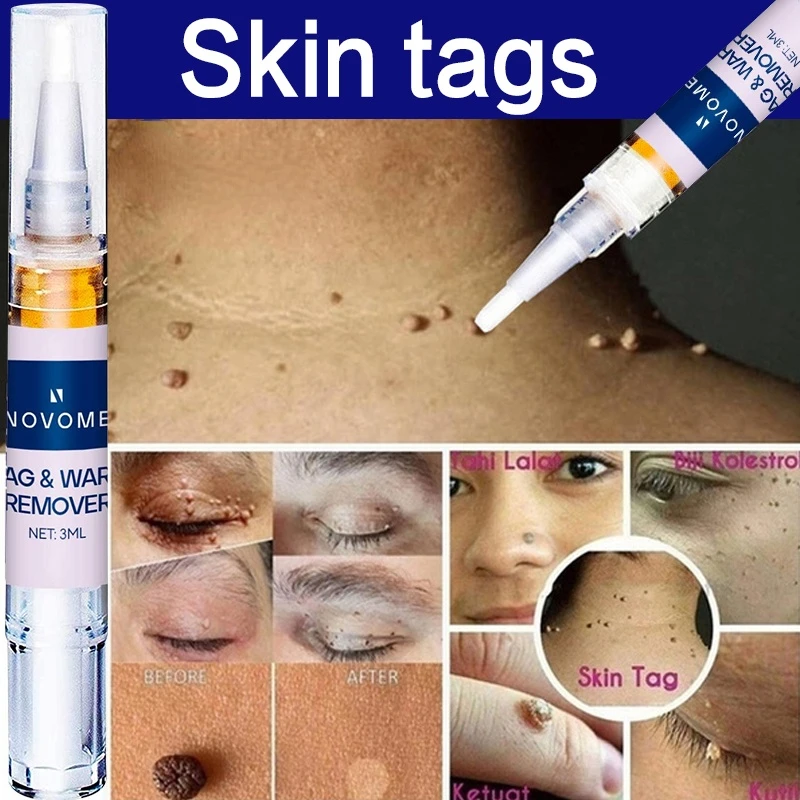 Removing Against Moles Liquid Pen Treatment Papillomas Removal Of Warts Liquid From Skin Tags Remover Anti Verruca Remedy
Removing Against Moles Liquid Pen Treatment Papillomas Removal Of Warts Liquid From Skin Tags Remover Anti Verruca Remedy