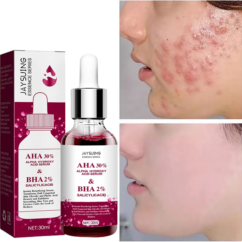 Fruit Acid Face Serum Effective Acne Treatment Oil Control Anti Dark Spot Shrink Pores Smooth Skin Improve Texture Beauty Health
Fruit Acid Face Serum Effective Acne Treatment Oil Control Anti Dark Spot Shrink Pores Smooth Skin Improve Texture Beauty Health