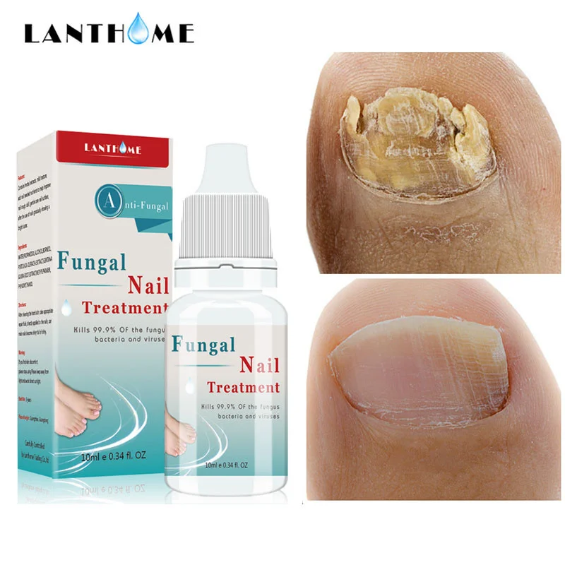 Nail Fungal Treatment Essence Removal Onychomycosis Paronychia Toes Fungus Anti Infection Repair Damaged Nail Bed Care Products
Nail Fungal Treatment Essence Removal Onychomycosis Paronychia Toes Fungus Anti Infection Repair Damaged Nail Bed Care Products