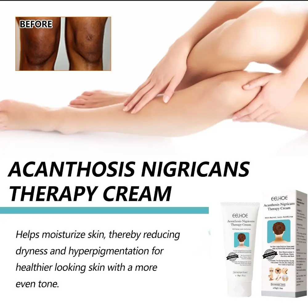 Dark Spot Remover Nigricans Therapy Cream Whitening Serum Dark Spot Corrector Cream Acanthosis Nigricans Therapy Cream
Dark Spot Remover Nigricans Therapy Cream Whitening Serum Dark Spot Corrector Cream Acanthosis Nigricans Therapy Cream