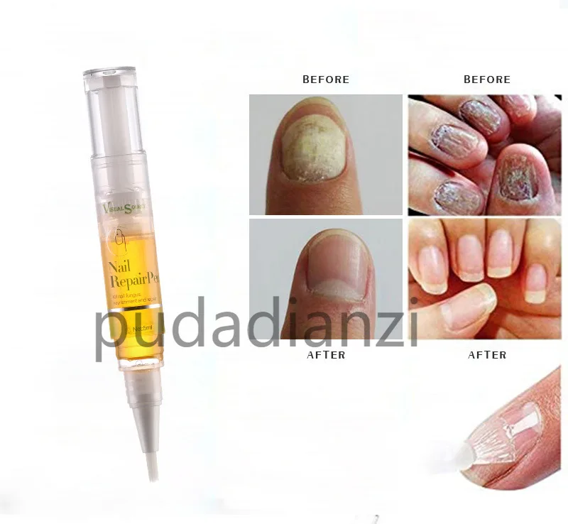20ML Nail Fungal Treatment Feet Care Essence Nail Foot Toe Nail Fungus Removal Gel Anti Infection Paronychia Onychomycosis
20ML Nail Fungal Treatment Feet Care Essence Nail Foot Toe Nail Fungus Removal Gel Anti Infection Paronychia Onychomycosis