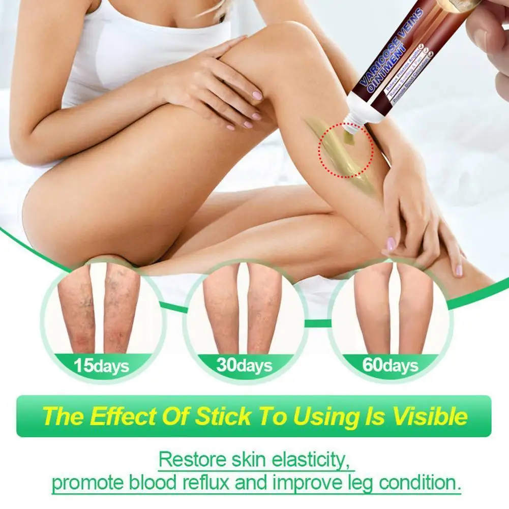 Varicose Veins Ointmnet Vasculitis Phlebitis Pain Relief Removal Medical Angiitis Herbal Ointment Plaster V4q5
Varicose Veins Ointmnet Vasculitis Phlebitis Pain Relief Removal Medical Angiitis Herbal Ointment Plaster V4q5