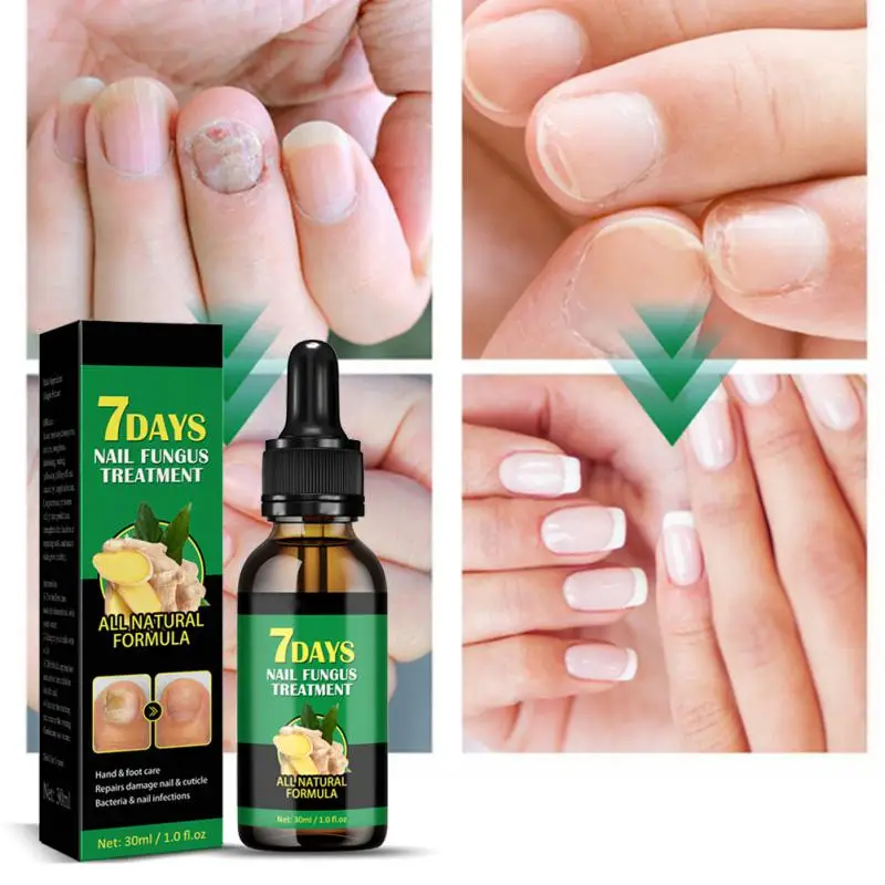 Быстрое средство для ухода за ногтями от грибков, средство для восстановления ногтей, гель для удаления грибка на ногтях, противоинфекционный крем, удаление грибков на ногтях 
Быстрое средство для ухода за ногтями от грибков, средство для восстановления ногтей, гель для удаления грибка на ногтях, противоинфекционный крем, удаление грибков на ногтях