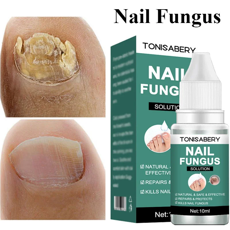 Nail Fungal Treatment Essence Anti Infection Paronychia Onychomycosis Nail Foot Toe Nail Fungus Removal Gel Feet Care Products
Nail Fungal Treatment Essence Anti Infection Paronychia Onychomycosis Nail Foot Toe Nail Fungus Removal Gel Feet Care Products