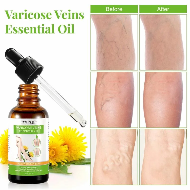 Herbal Effective Varicose Veins Treatment Spray Removal Vasculitis Phlebitis Spider Leg Pain Relief Angiitis Body Care Products
Herbal Effective Varicose Veins Treatment Spray Removal Vasculitis Phlebitis Spider Leg Pain Relief Angiitis Body Care Products