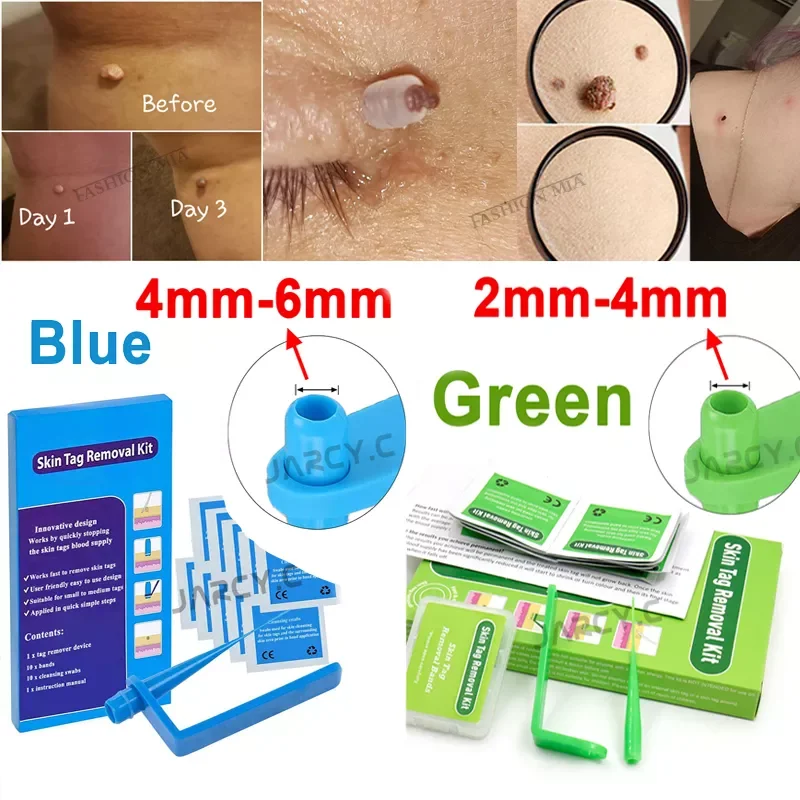 Skin Tag Removal Kit Papillomas Treatment Skin Cleansing Tools Micro Band 4-6mm For Berrugas Warts Remove Mole Wart Face Care
Skin Tag Removal Kit Papillomas Treatment Skin Cleansing Tools Micro Band 4-6mm For Berrugas Warts Remove Mole Wart Face Care