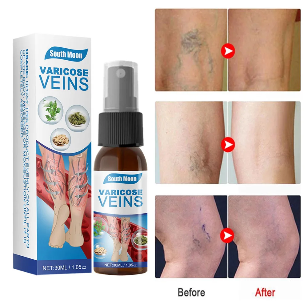 30ml Varicose Vein Soothing Spray Relieve Leg Swelling Pains Varicose Veins Treatment Spray For Vasculitis Phlebitis Health Care
30ml Varicose Vein Soothing Spray Relieve Leg Swelling Pains Varicose Veins Treatment Spray For Vasculitis Phlebitis Health Care