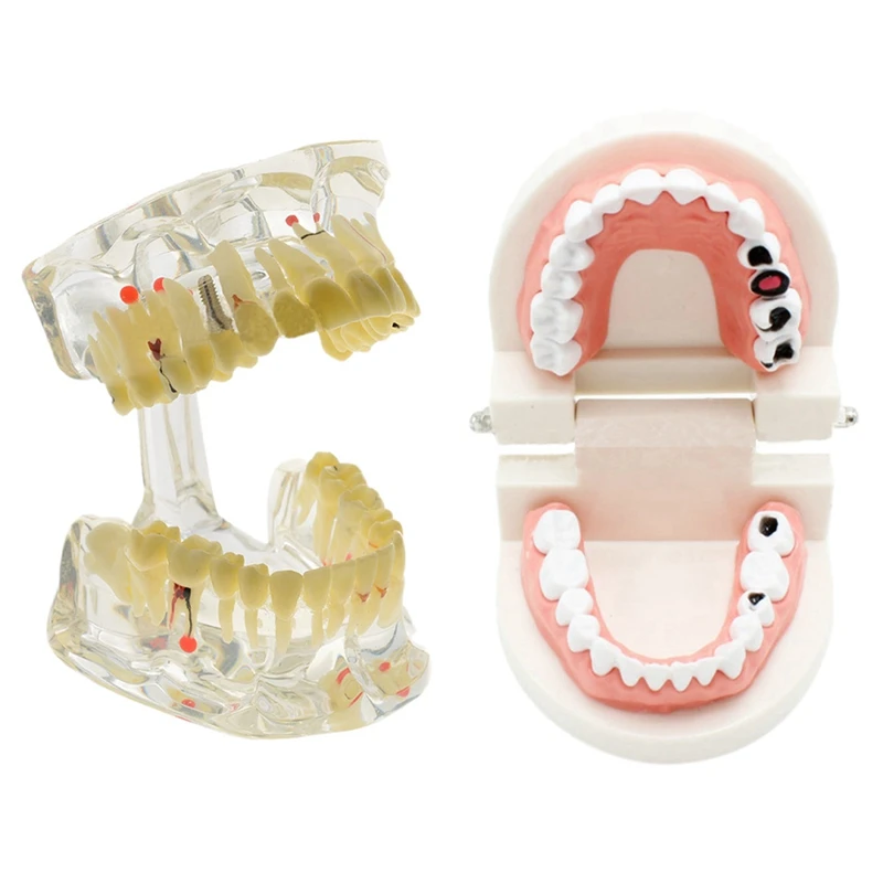 2 Pcs Implant Disease Teeth Model With Restoration Bridge Dentist For Science Disease Teaching Study
2 Pcs Implant Disease Teeth Model With Restoration Bridge Dentist For Science Disease Teaching Study