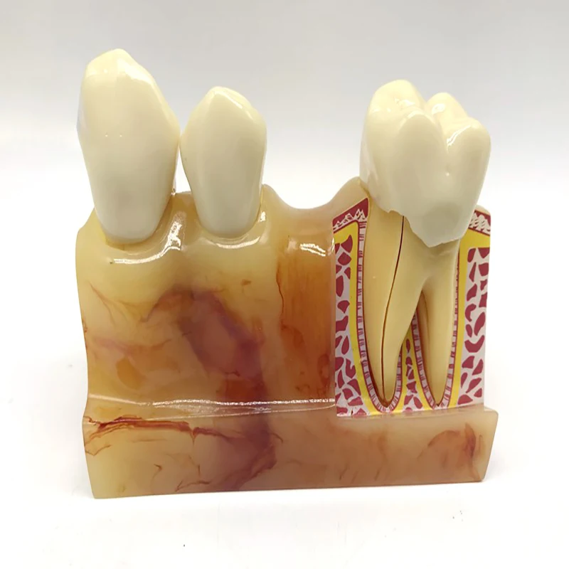 Quadfold Dental Decomposition Model Dental Decomposition Model Oral Teaching Materials Communication Model
Quadfold Dental Decomposition Model Dental Decomposition Model Oral Teaching Materials Communication Model