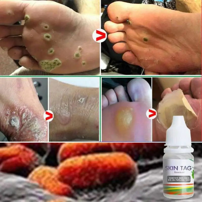 Wart Remover Serum Clean Painless Mole Skin Dark Spot Warts Remover Face Wart Tag Treatments Fast Acting Body Skin Care Repair
Wart Remover Serum Clean Painless Mole Skin Dark Spot Warts Remover Face Wart Tag Treatments Fast Acting Body Skin Care Repair