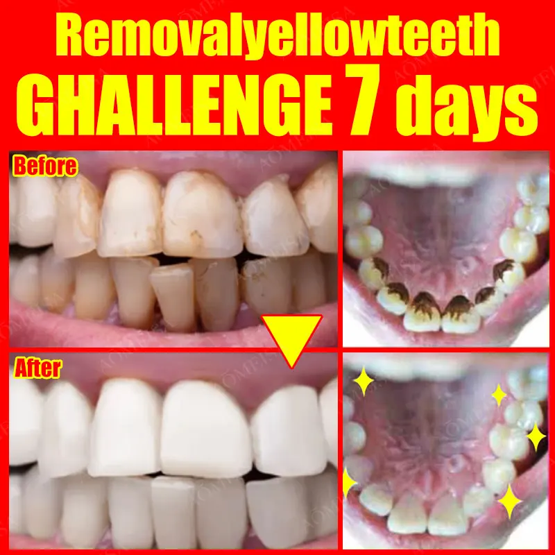 Tooth Stain Removal Gum Bleeding Whitening Deep Cleaning Dental Plaque Oral
Tooth Stain Removal Gum Bleeding Whitening Deep Cleaning Dental Plaque Oral