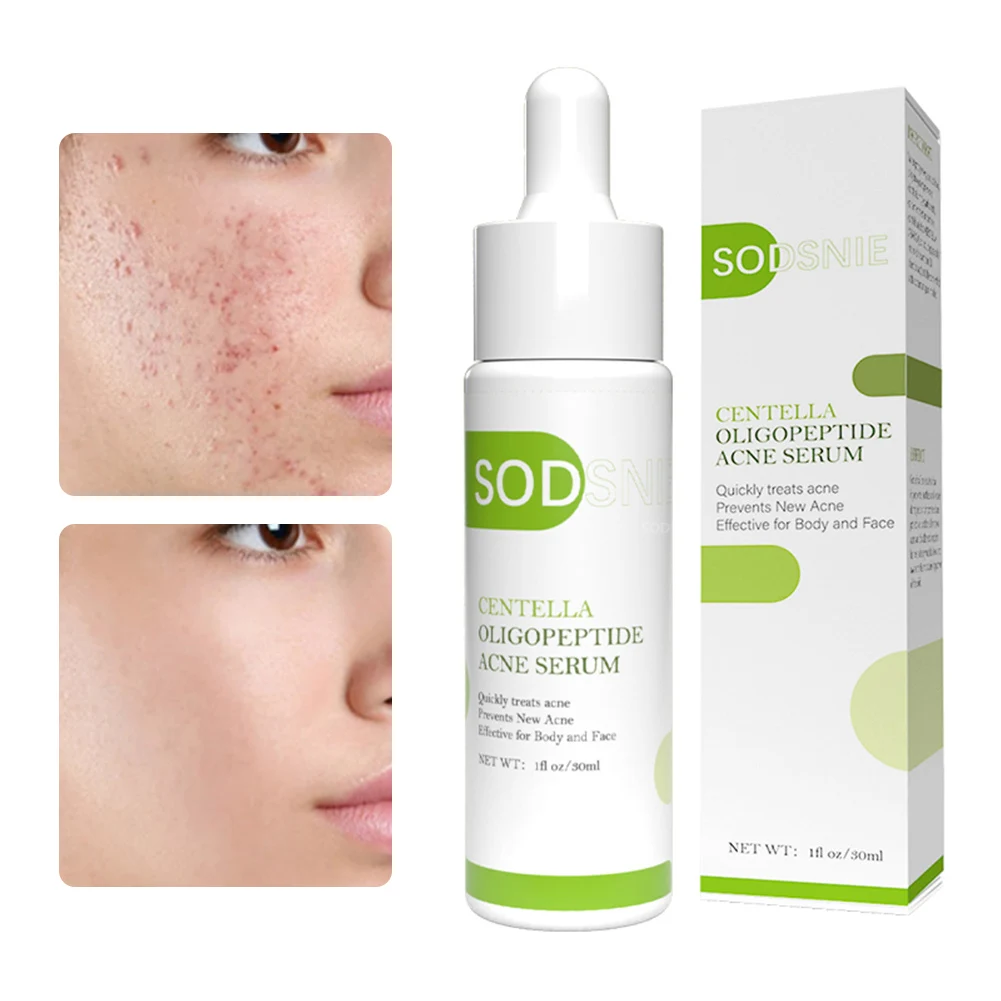 30ml Acne Treatment Serum Lighten Acne Marks Relieve Redness Acne Pimples Removal Serum Facial Repairing Face Skin Care Essence
30ml Acne Treatment Serum Lighten Acne Marks Relieve Redness Acne Pimples Removal Serum Facial Repairing Face Skin Care Essence