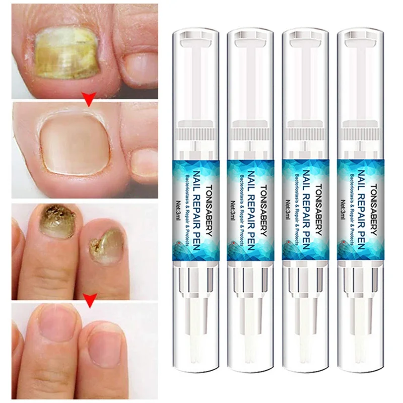 4pcs Fungal Nail Repair Pen Natural Formula Nail Repair Liquid Pen For Onychomycosis Paronychia Discoloration Fungus Nail Care
4pcs Fungal Nail Repair Pen Natural Formula Nail Repair Liquid Pen For Onychomycosis Paronychia Discoloration Fungus Nail Care