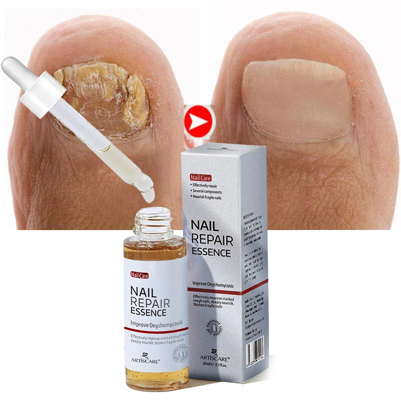 Nail Fungal Treatment Essence Products Anti Infection Paronychia Onychomycosis Removal Repair Serum Hand Foot Toe Fungus Care
Nail Fungal Treatment Essence Products Anti Infection Paronychia Onychomycosis Removal Repair Serum Hand Foot Toe Fungus Care