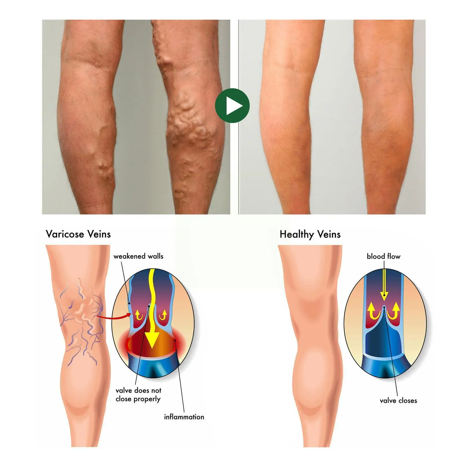 60 шт./5 пакетов, пластырь для варикозного расширения вен
60 шт./5 пакетов, пластырь для варикозного расширения вен