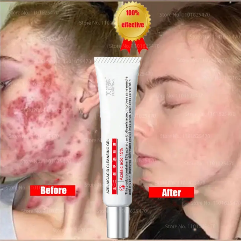 15% Azelaic Acid Gel Acne Cream Dispels Acne and Mildly Brightens The Skin Azelaic Acid Ointment
15% Azelaic Acid Gel Acne Cream Dispels Acne and Mildly Brightens The Skin Azelaic Acid Ointment