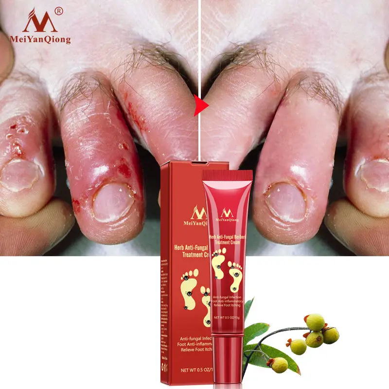 3pcs Herb Nail Fungus Treatment Anti-fungal Infection Foot Anti-inflammatory Onychomycosis Chinese Toe Nail Treatment Cream
3pcs Herb Nail Fungus Treatment Anti-fungal Infection Foot Anti-inflammatory Onychomycosis Chinese Toe Nail Treatment Cream