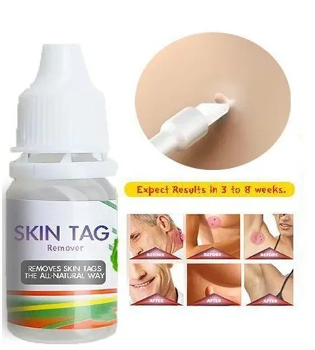 Skin-Tag Get rid of warts quickly, remove growths, treat wart liquid, remove chicken liquid, remove warts
Skin-Tag Get rid of warts quickly, remove growths, treat wart liquid, remove chicken liquid, remove warts