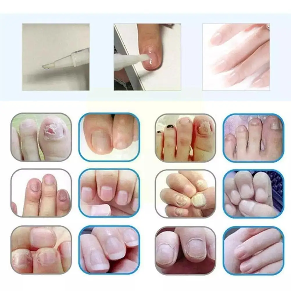 3ml Effective Skin Tag Remover Pen Skin Repair Pen Genital Kill Wart Liquid & Corn Mole Tag Remover Foot Skin Medical Remov U7z6
3ml Effective Skin Tag Remover Pen Skin Repair Pen Genital Kill Wart Liquid & Corn Mole Tag Remover Foot Skin Medical Remov U7z6