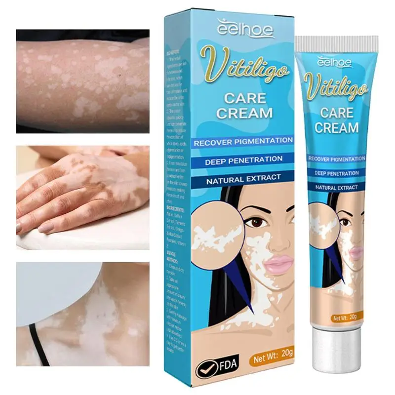 Vitiligo Cream White Spots On Skin Repigmentation And Relief Cream 20g Reduce White Spots Improve Epidermal Melanocytes
Vitiligo Cream White Spots On Skin Repigmentation And Relief Cream 20g Reduce White Spots Improve Epidermal Melanocytes