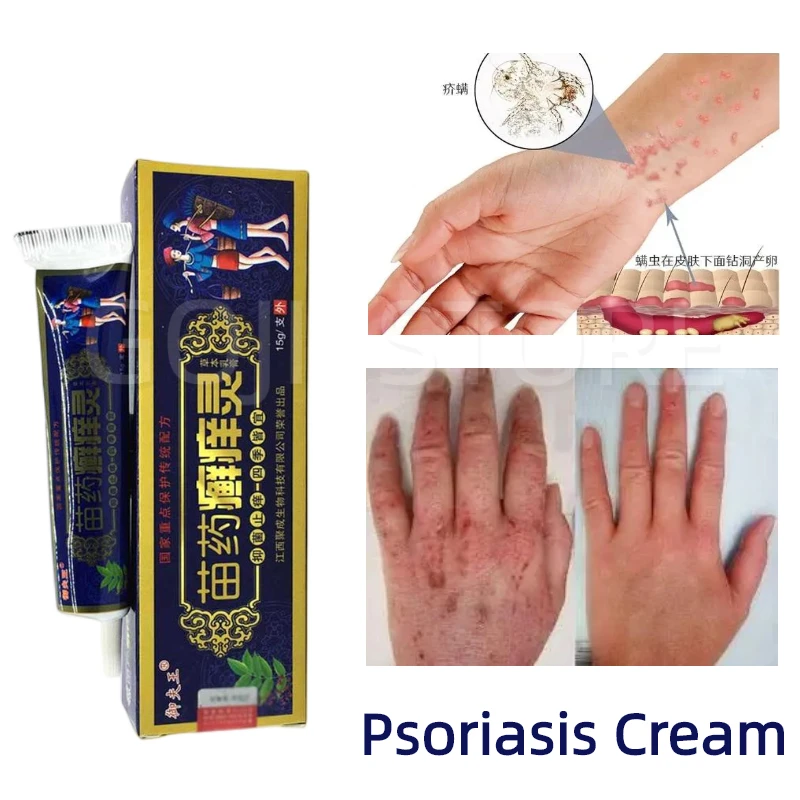 10pcs Bacteriostatic Psoriasis Cream Skin repair Dermatitis Eczematoid Eczema Ointment Treatment Psoriasis itch Cream Skin Care
10pcs Bacteriostatic Psoriasis Cream Skin repair Dermatitis Eczematoid Eczema Ointment Treatment Psoriasis itch Cream Skin Care