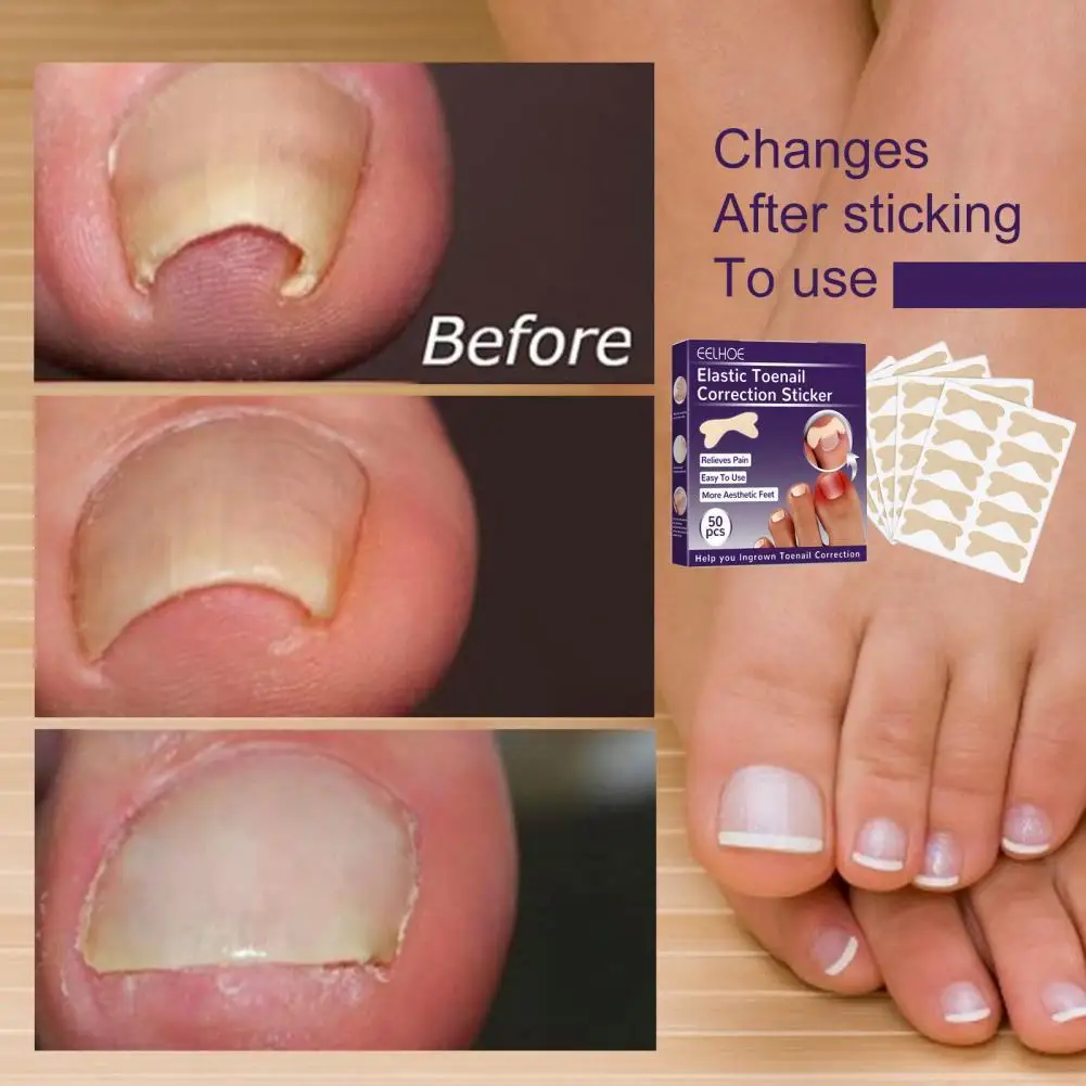 50Pcs/Set Toenail Patches Self-Adhesive Waterproof Breathable Correction Stickers Ingrown Recover Corrector for Foot
50Pcs/Set Toenail Patches Self-Adhesive Waterproof Breathable Correction Stickers Ingrown Recover Corrector for Foot
