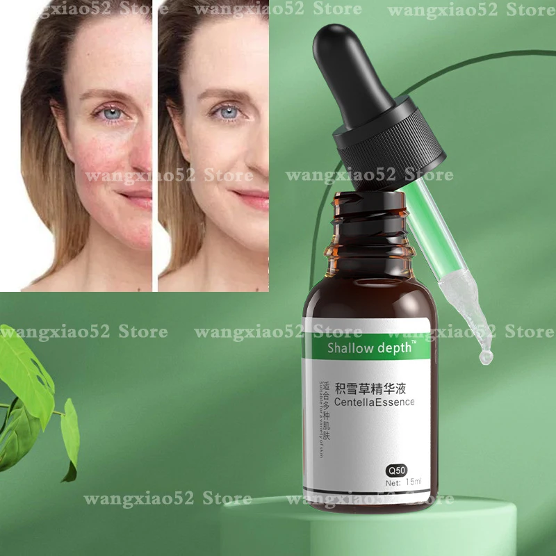 Centella asiatica essence dilutes acne marks, acne pits, repairs redness, shrinks pores, hydrates, moisturizes skin care
Centella asiatica essence dilutes acne marks, acne pits, repairs redness, shrinks pores, hydrates, moisturizes skin care