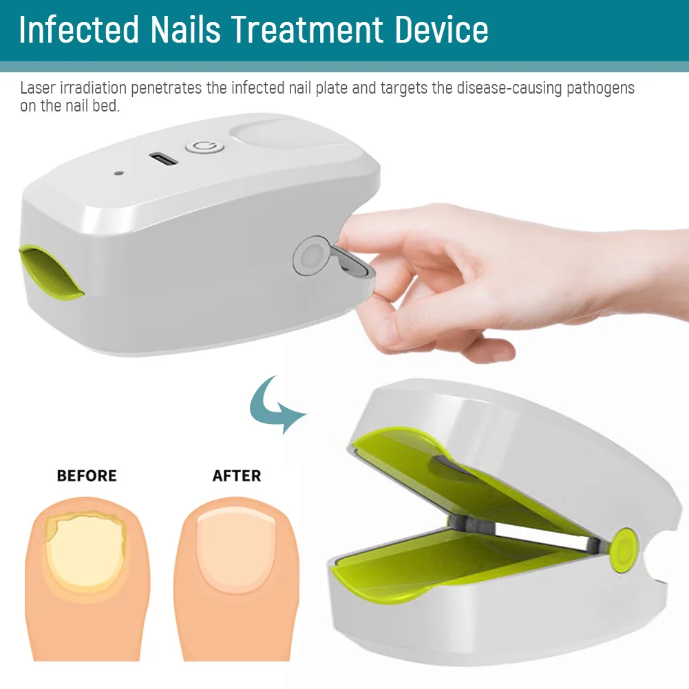 905NM Nail Fungus Laser Therapy Device USB Charging Painless Nail Fungus Laser Instrument Anti-Slip Silicone for Foot Care Tools
905NM Nail Fungus Laser Therapy Device USB Charging Painless Nail Fungus Laser Instrument Anti-Slip Silicone for Foot Care Tools