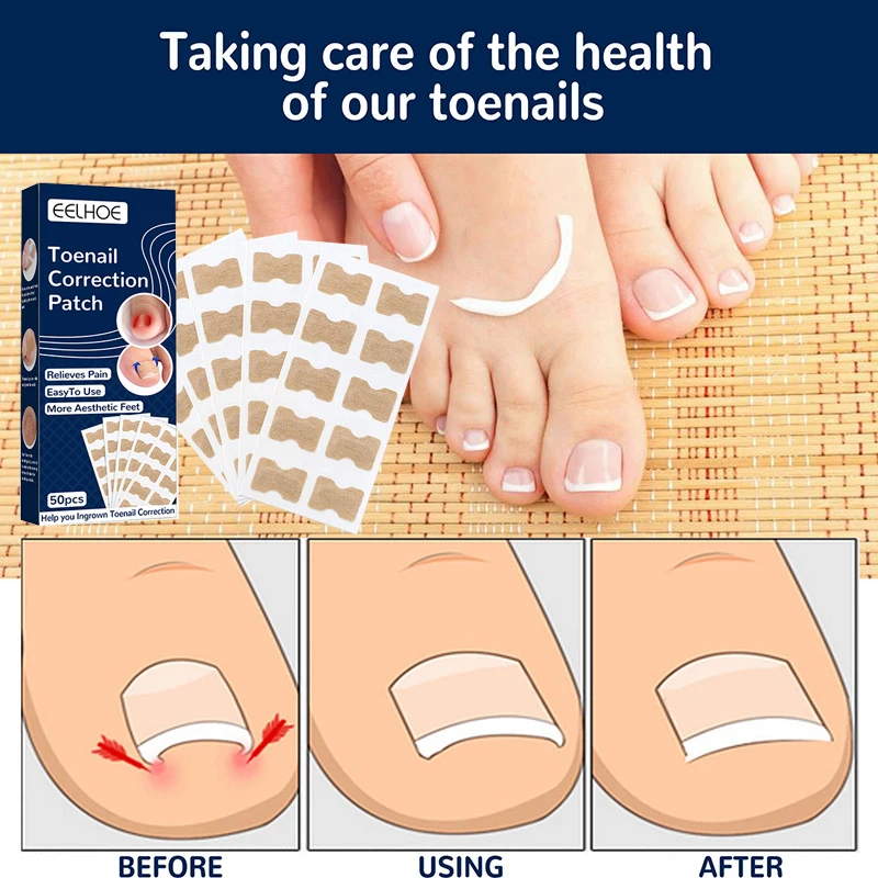 50pcs Nail Correction Stickers Ingrown Toenail Corrector Patches Waterproof Health Care Relief Pain Recover Pedicure Tool
50pcs Nail Correction Stickers Ingrown Toenail Corrector Patches Waterproof Health Care Relief Pain Recover Pedicure Tool