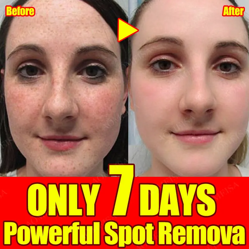 Whitening Spot Serum Remove Freckles Chloasma Dark Spots Hyperpigmentation Age Spots Sun Spots Light Spots And Brighten Skin
Whitening Spot Serum Remove Freckles Chloasma Dark Spots Hyperpigmentation Age Spots Sun Spots Light Spots And Brighten Skin