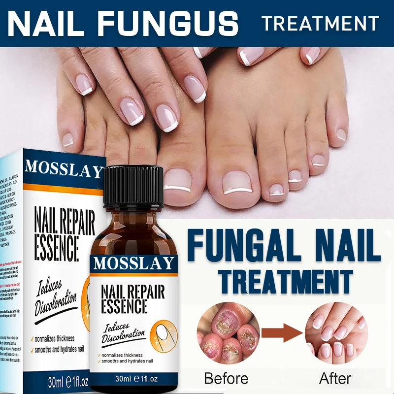 Repair Foot Nail Fungus Removal Gel Anti Infection Paronychia Onychomycosis Product
Repair Foot Nail Fungus Removal Gel Anti Infection Paronychia Onychomycosis Product