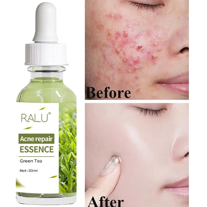 Acne Treatment Face Serum Repair Acne Fade Acne Marks Tighten Skin Shrink Pores Oil Control Moisturizing Skin Care Beauty Health
Acne Treatment Face Serum Repair Acne Fade Acne Marks Tighten Skin Shrink Pores Oil Control Moisturizing Skin Care Beauty Health