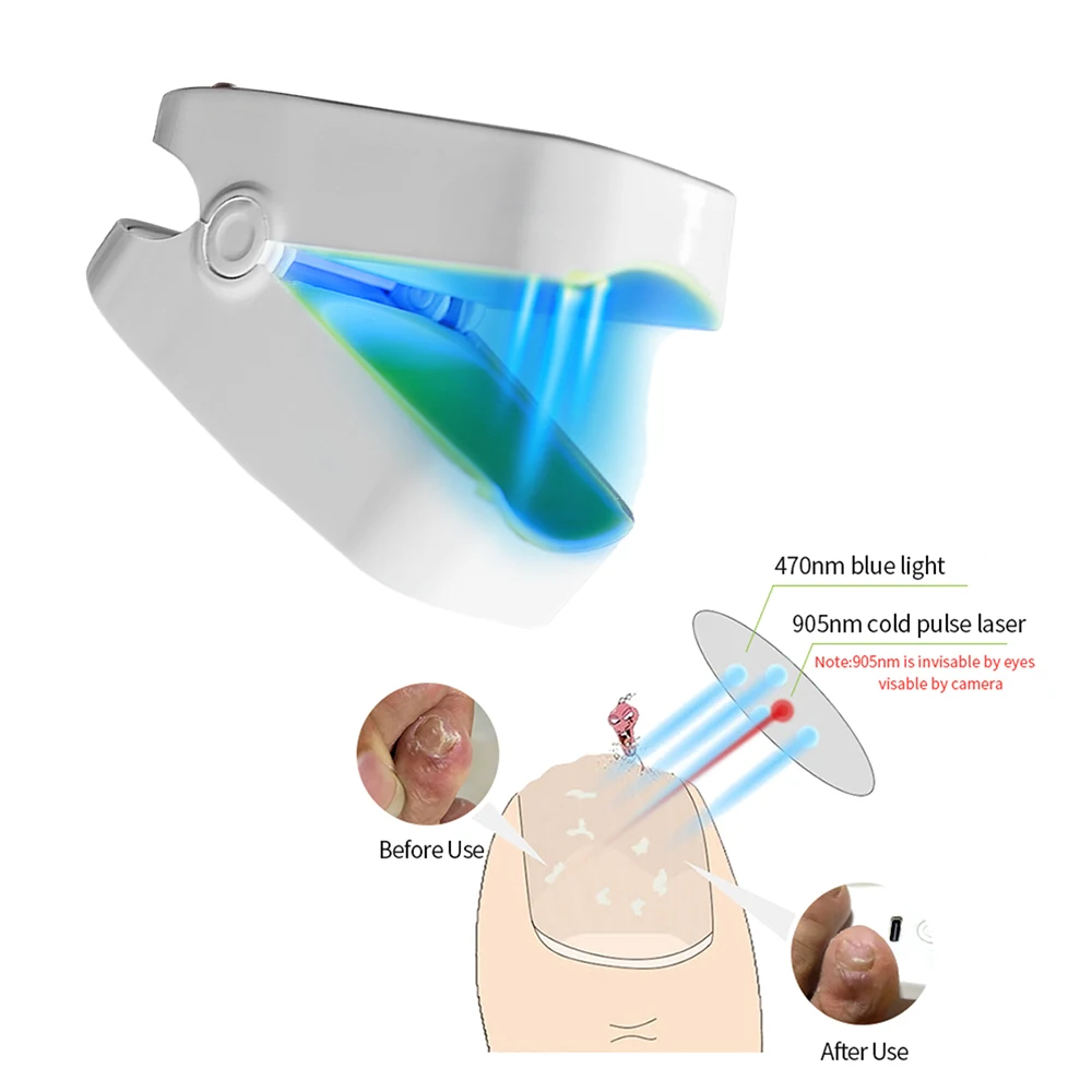 Устройство для лечения грибка ногтей с USB-зарядкой
Устройство для лечения грибка ногтей с USB-зарядкой