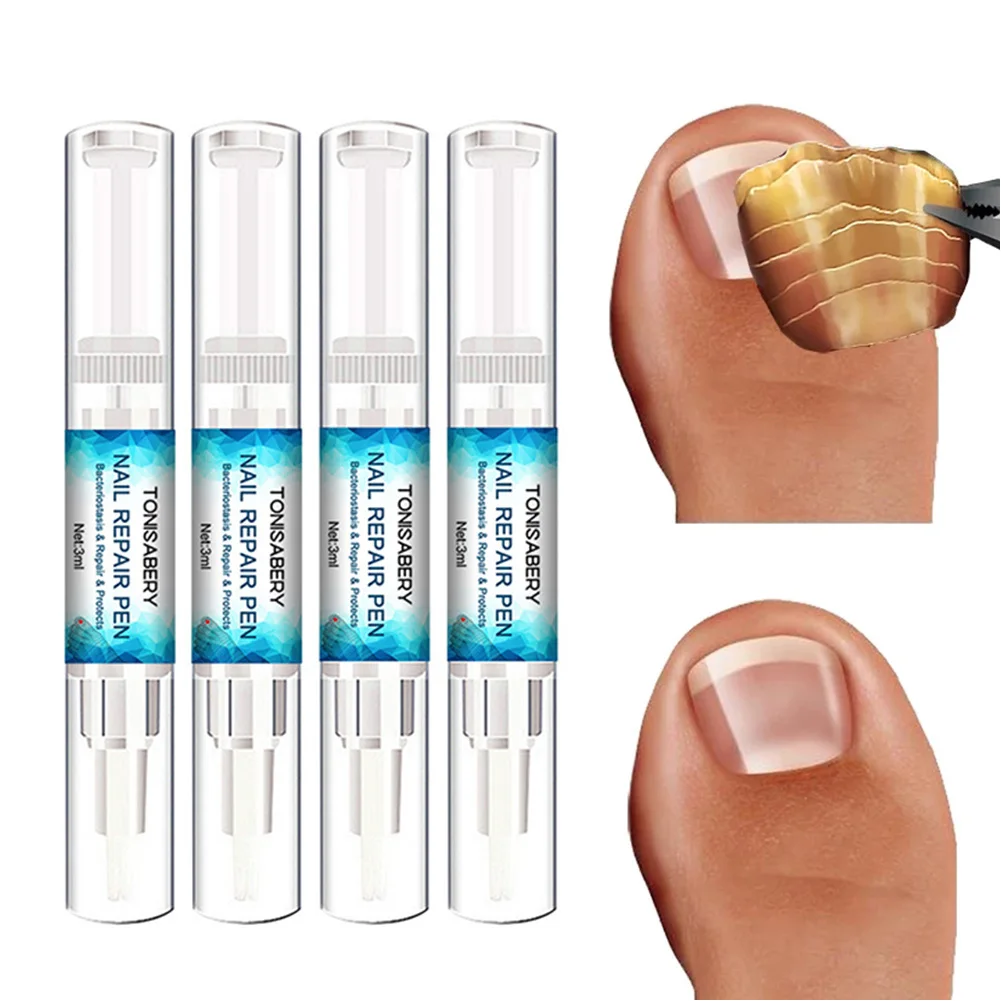 4pcs Fungal Nail Repair Pen Natural Formula Nail Repair Liquid Pen For Onychomycosis Paronychia Discoloration Fungus Nail Care
4pcs Fungal Nail Repair Pen Natural Formula Nail Repair Liquid Pen For Onychomycosis Paronychia Discoloration Fungus Nail Care