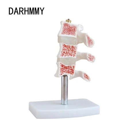 Модель анатомии остеопороза DARHMMY Cutaway, разрезание кости, демонстрационная модель GIOP