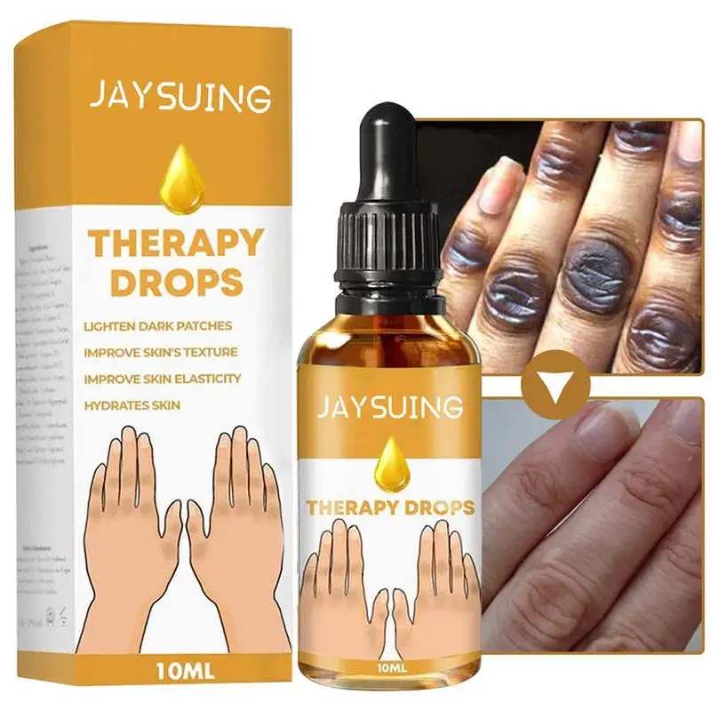 Acanthosis Nigricans Essential Oil Removing Dark Knuckle Elbow And Knee Dark Spots Remover 10ml Day And Night Moisturizer For Dr
Acanthosis Nigricans Essential Oil Removing Dark Knuckle Elbow And Knee Dark Spots Remover 10ml Day And Night Moisturizer For Dr