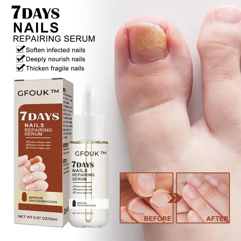 Nail Fungal Treatment Serum Paronychia Anti Infection Toe Fungus Hand Foot Onychomycosis Removal Repair Beauty Health
Nail Fungal Treatment Serum Paronychia Anti Infection Toe Fungus Hand Foot Onychomycosis Removal Repair Beauty Health
