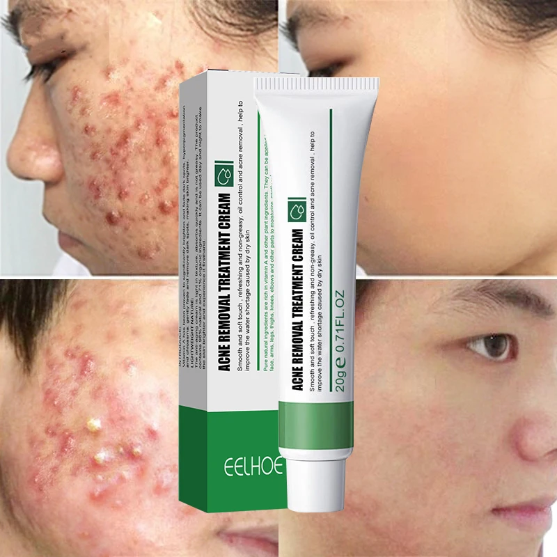 Effective Acne Treatment Cream Remove Acne Blackheads Pimples Marks Control Oil Shrinking Pores Whitening Moisturizing Skin Care
Effective Acne Treatment Cream Remove Acne Blackheads Pimples Marks Control Oil Shrinking Pores Whitening Moisturizing Skin Care