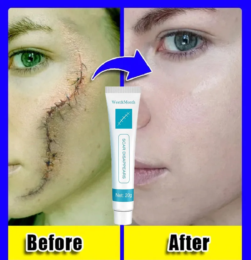 Fast Scar Removal Cream Repair Stretch Marks Burn Surgical Acne Scars Treatment Pigmentation Whitening Moisturizing Skin Care
Fast Scar Removal Cream Repair Stretch Marks Burn Surgical Acne Scars Treatment Pigmentation Whitening Moisturizing Skin Care