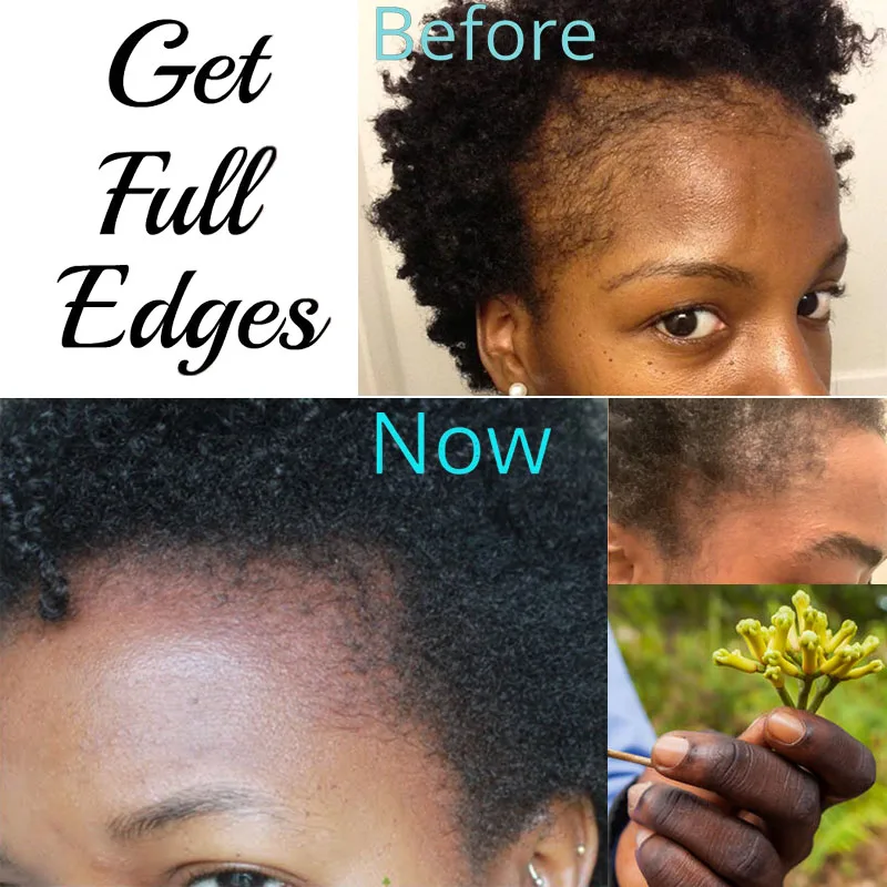 

Hair Oils Solutions for Traction Alopecia Ayurvedic Herbs and Powders for Natural Hair Growth Clove The Secret To Grow Edge Back