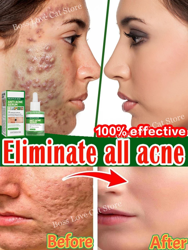 

Acne Treatment Facial Serum Pore Shrinking Skin Care Against Face Acne Pimple Dark Spots Remover Cleaning Salicylic Acid Serum