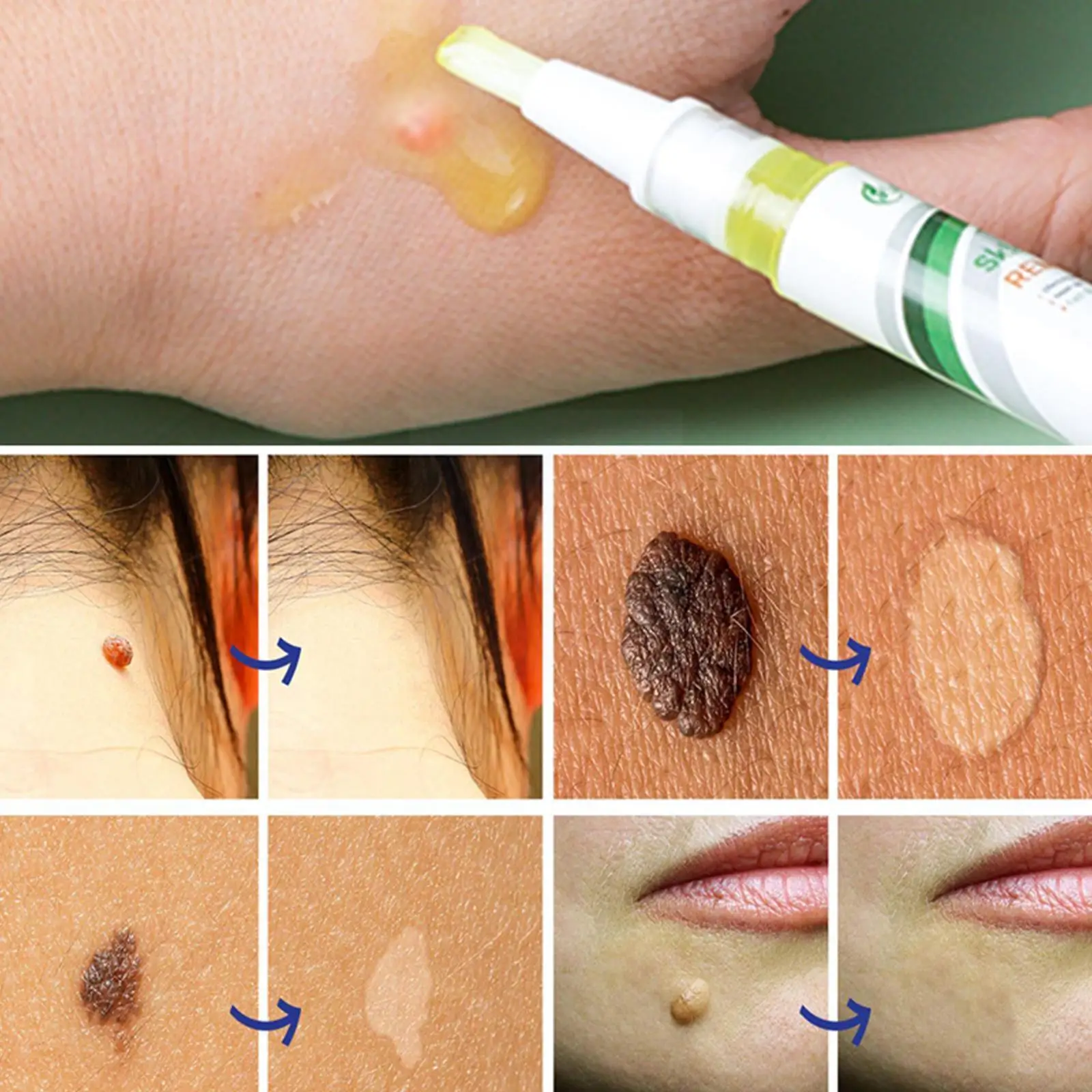 Beauty Health Skin Care Removal Of Warts Liquid Warts Verruca Remedy Remover Moles Against Pen Removing Anti T1N1
Beauty Health Skin Care Removal Of Warts Liquid Warts Verruca Remedy Remover Moles Against Pen Removing Anti T1N1