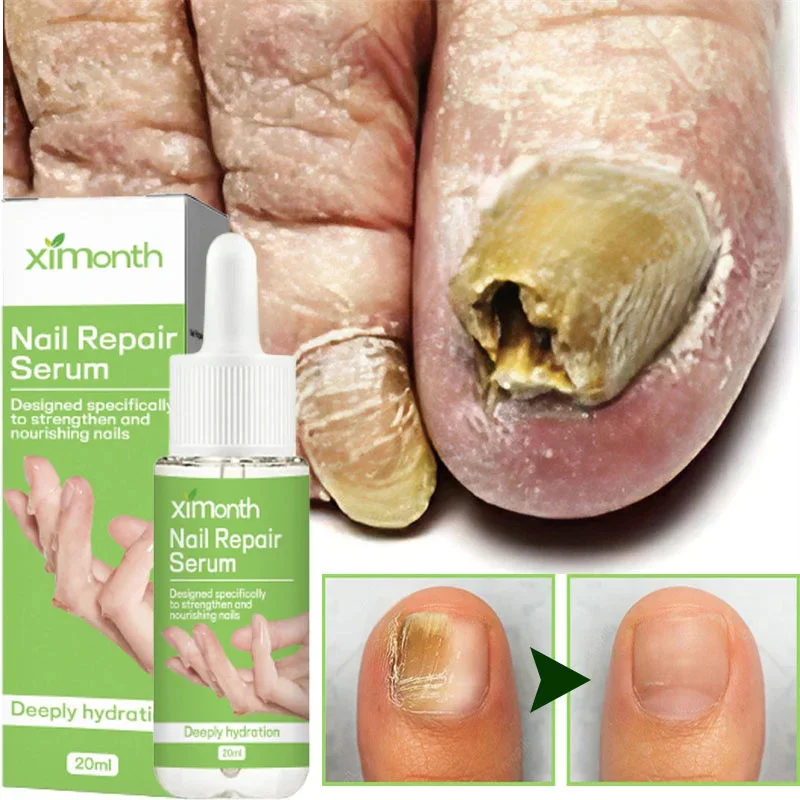 

Сыворотка для лечения грибка ногтей, эссенция для восстановления ног, средство для удаления грибка на ногах, средство против инфекции для паронихии и онихомикоза 20 мл