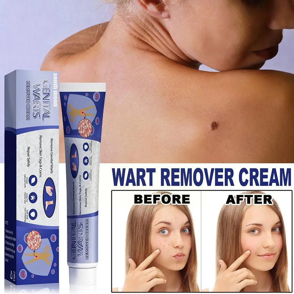 Warts Remover Ointment Cream Skin Tags Removal Gel Remover Face Mole Wart Care Treatment Body Warts Removal Body E0S5
Warts Remover Ointment Cream Skin Tags Removal Gel Remover Face Mole Wart Care Treatment Body Warts Removal Body E0S5
