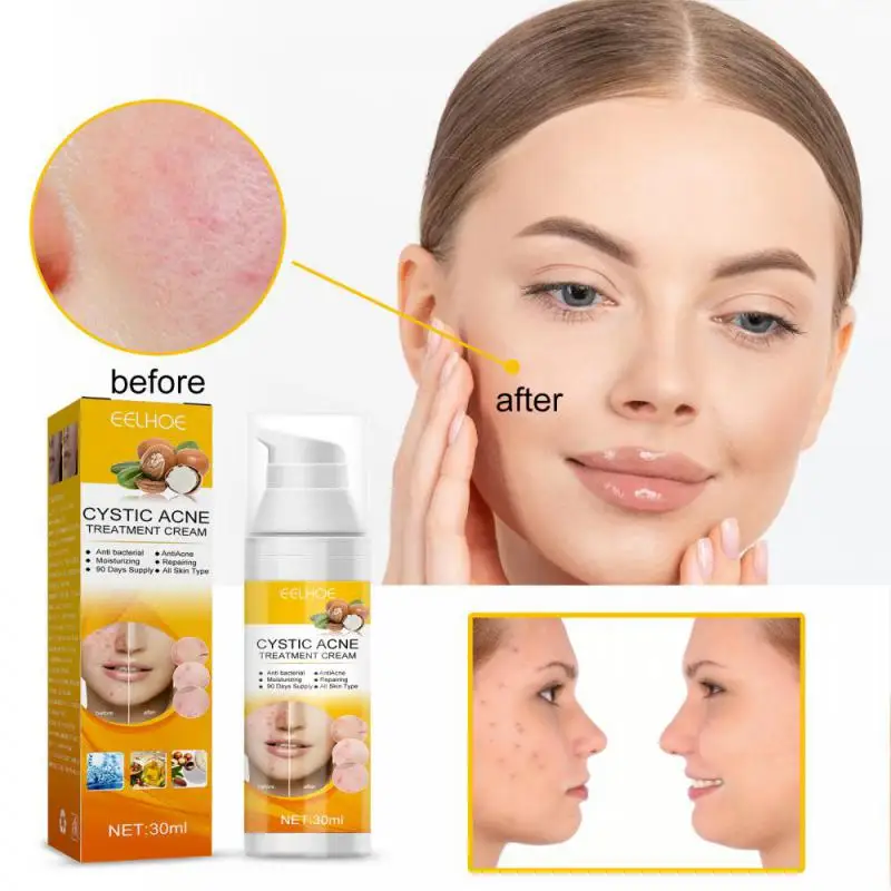 Face Serum Acne Removal Skin Care Reduce Acne Spots Essence Eliminate Mouth Closing Acne Shrink Pore Essence Cosmetics Makeup
Face Serum Acne Removal Skin Care Reduce Acne Spots Essence Eliminate Mouth Closing Acne Shrink Pore Essence Cosmetics Makeup