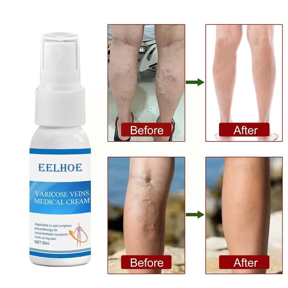 Varicose Vein Soothing Spray Treatment Of Varicose Leg On Acidic Veins Itchy Worm Lumps Sprays Spray Pigs Solution That Nat M2w3
Varicose Vein Soothing Spray Treatment Of Varicose Leg On Acidic Veins Itchy Worm Lumps Sprays Spray Pigs Solution That Nat M2w3