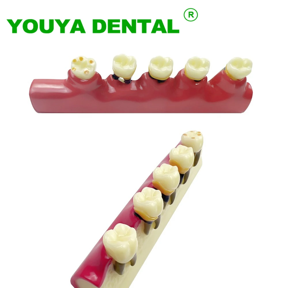 

Teeth Periodontal Disease Model Dental Caries Breakdown Display Periodontitis Show Teaching Tooth Model Dentistry Lab Products