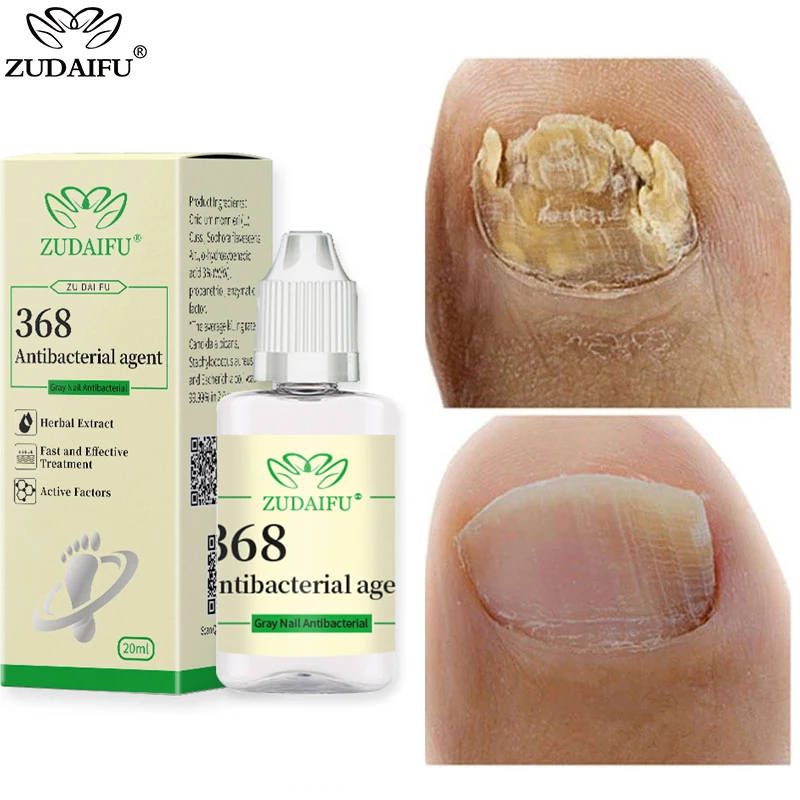Zudaifu Nail Fungus Treatment Essence Serum Care Hand and Foot Care Nail Foot Toe Nail Fungus Removal Gel Products
Zudaifu Nail Fungus Treatment Essence Serum Care Hand and Foot Care Nail Foot Toe Nail Fungus Removal Gel Products