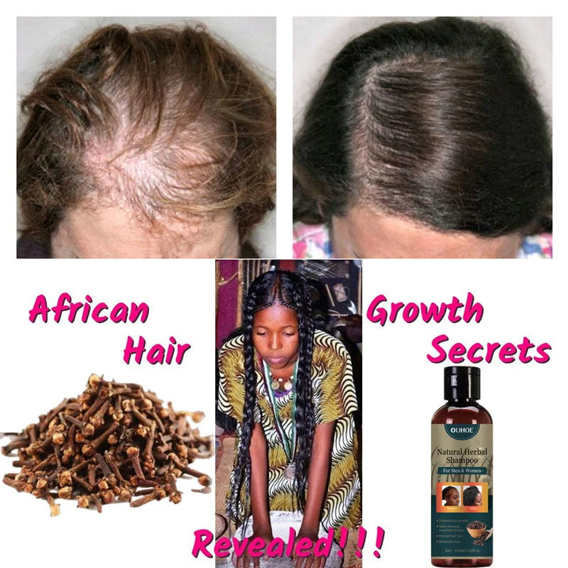 

Африканский продукт для роста волос Sdotter для женщин, средство для ухода за волосами Alopecia для мужчин, дешевый порошок, шампунь против выпадения волос, лечение и избавление от