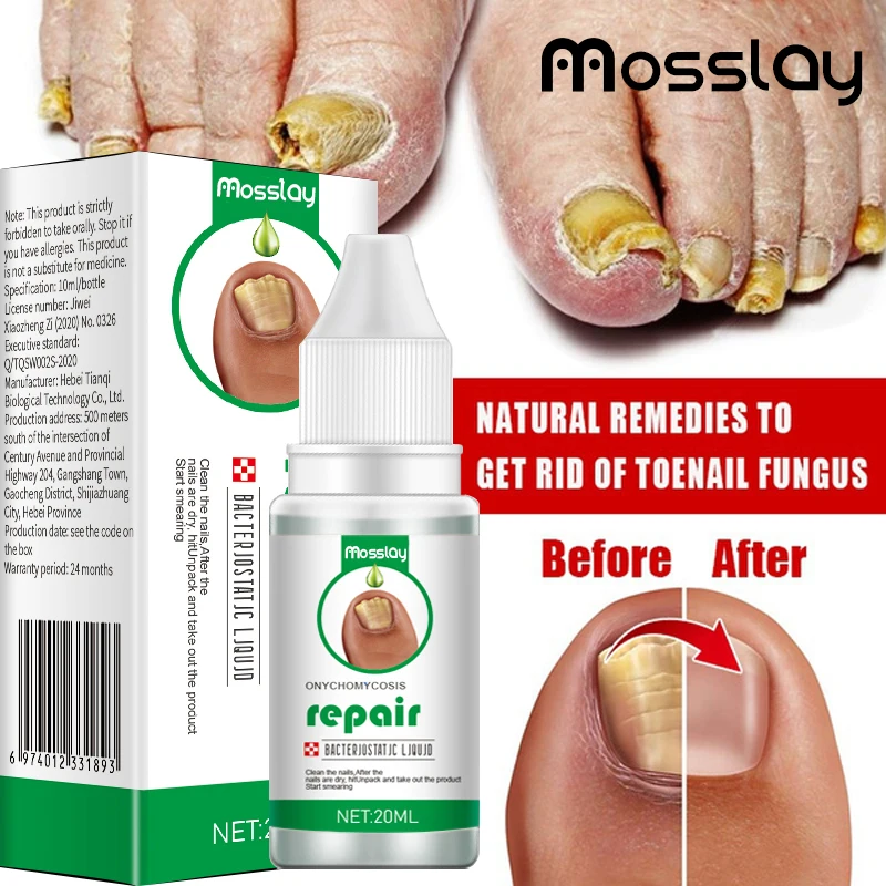 Mosslay Extra Strong Nail Fungal Treatment Feet Care Essence Best Foot Repair Nail Set Anti Infection Paronychia Onychomycosis
Mosslay Extra Strong Nail Fungal Treatment Feet Care Essence Best Foot Repair Nail Set Anti Infection Paronychia Onychomycosis
